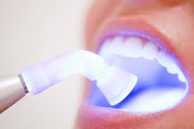 blaqueamiento dental - laser